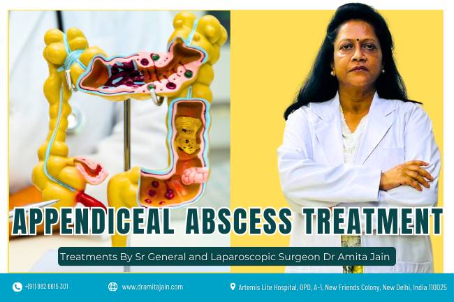 Dr Amita Jain best surgeon for Appendiceal Abscess